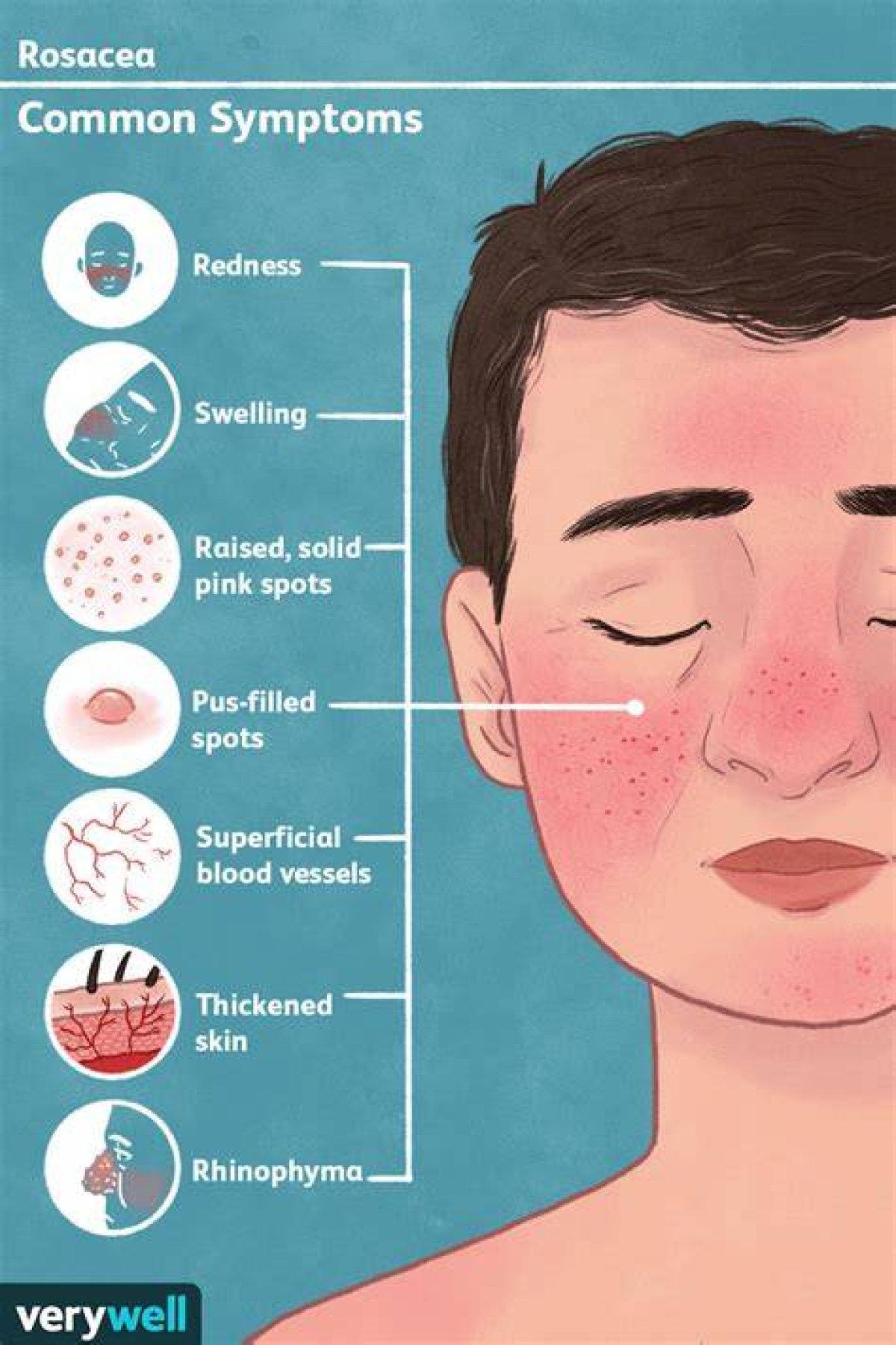 Are Rosacea and Folliculitis Related?