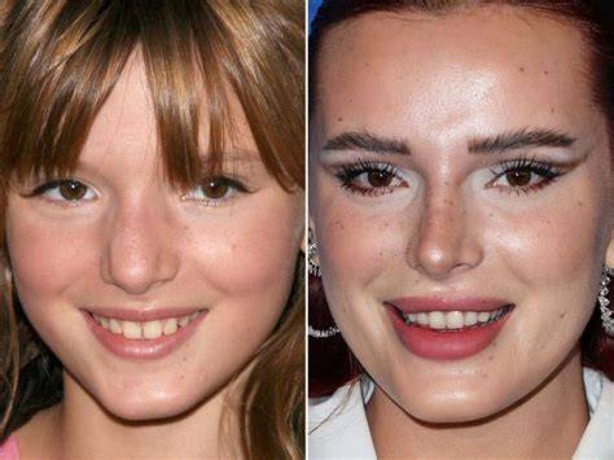 Behind the Speculations: Bella Thorne's Plastic Surgery
