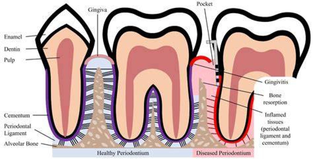 Body Part That Could Suffer from Periodontal Disease