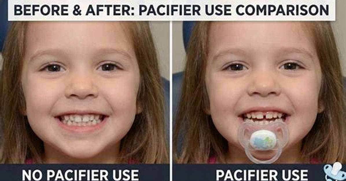 Can Braces Fix Pacifier Teeth?