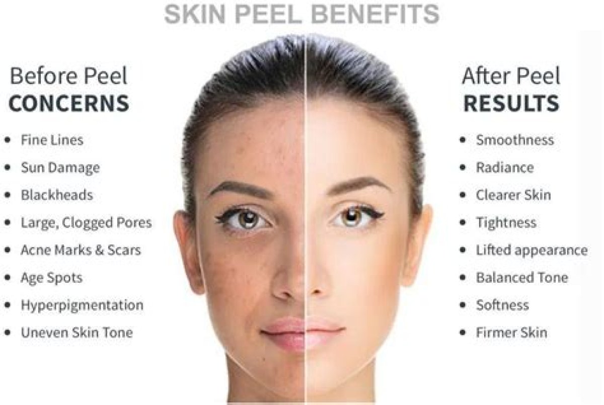 Can Chemical Peels Cause Acne?