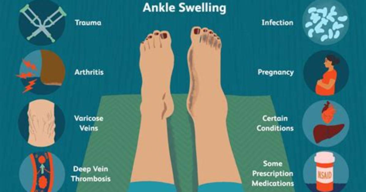 Can Dehydration Cause Ankle Swelling?