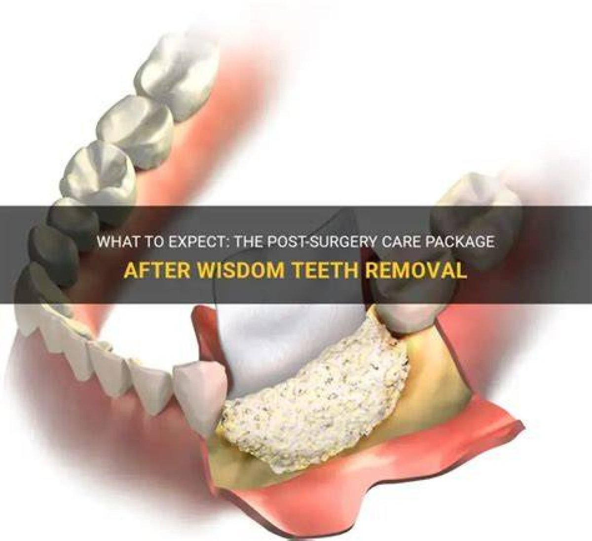 Can I Shower After Wisdom Teeth Removal?