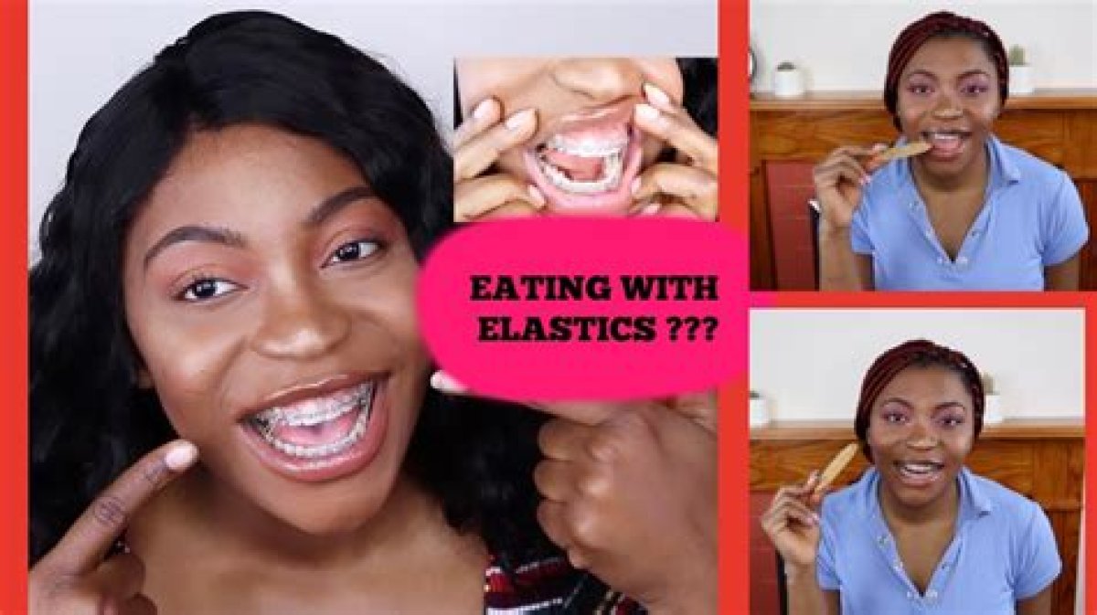 Can You Eat with Elastics on Braces?