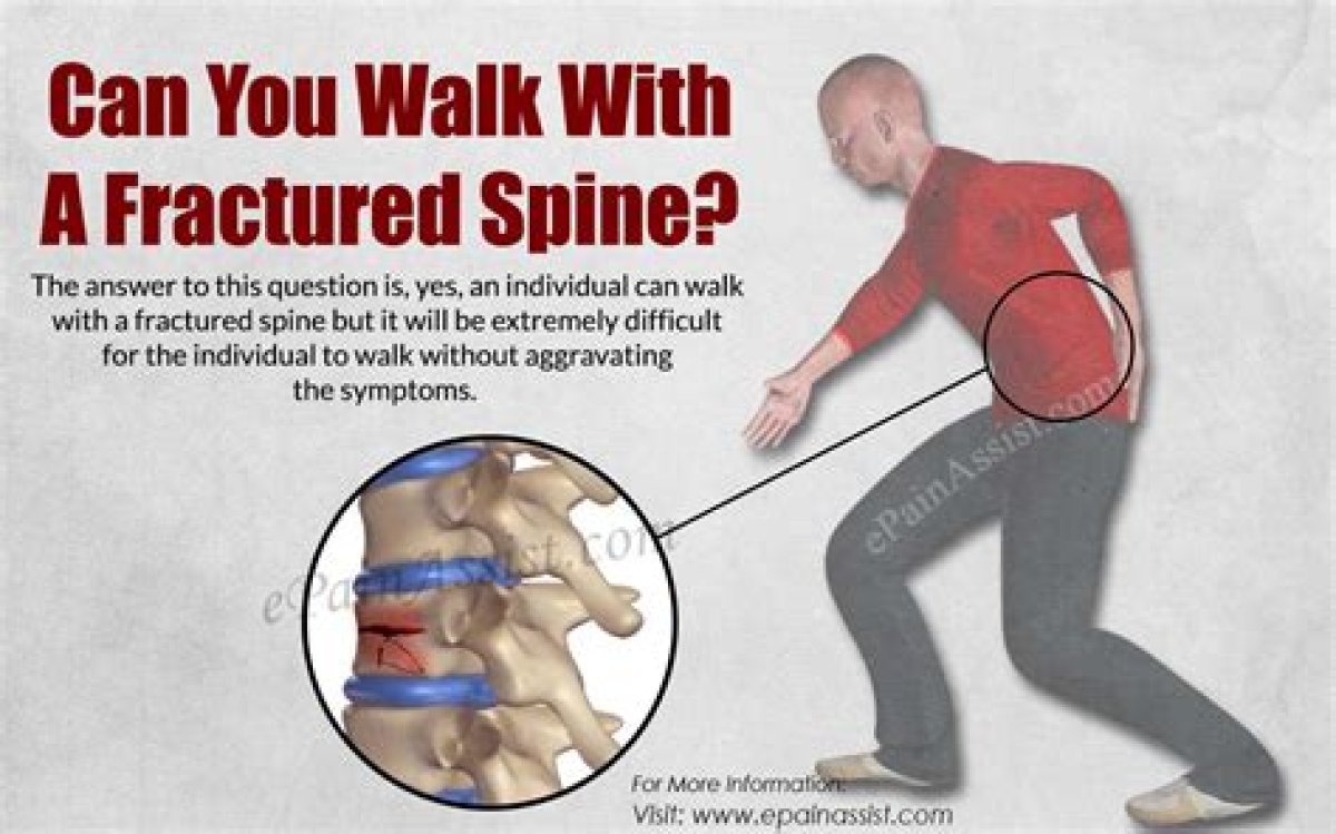 Can You Walk Around with a Fractured Pelvis?
