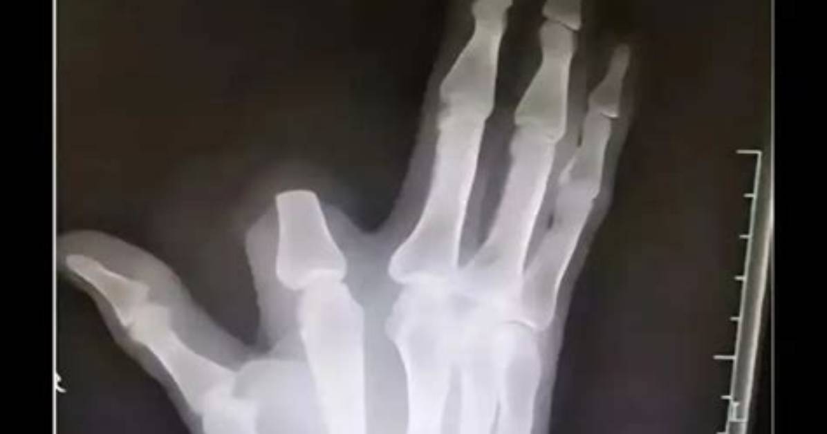 Chinese Farmer Cuts off Finger After Being Bitten by Snake. Doctors Tell Him He Needn’t Have Bothered