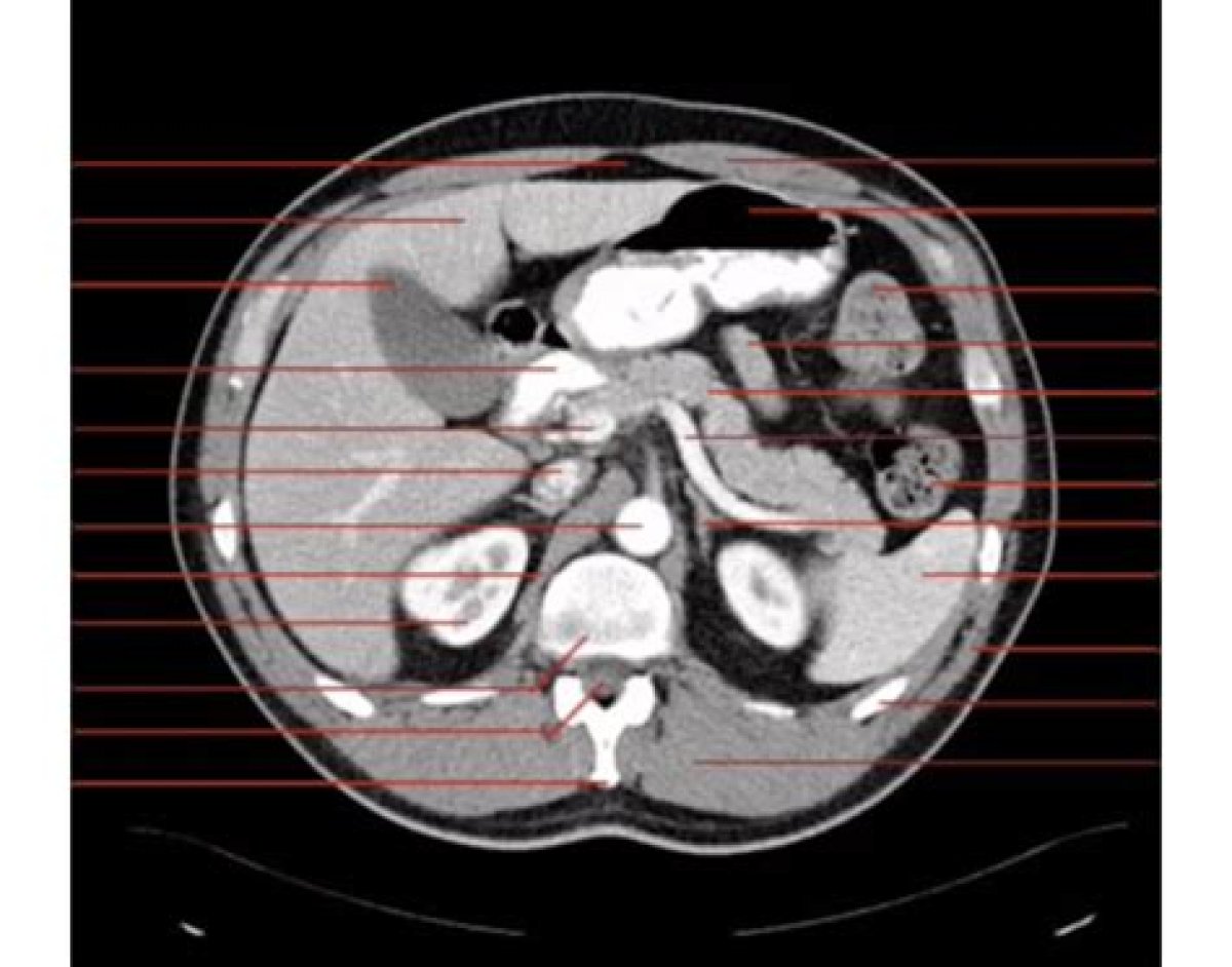 Ct Abdomen Axial Anatomy Quiz