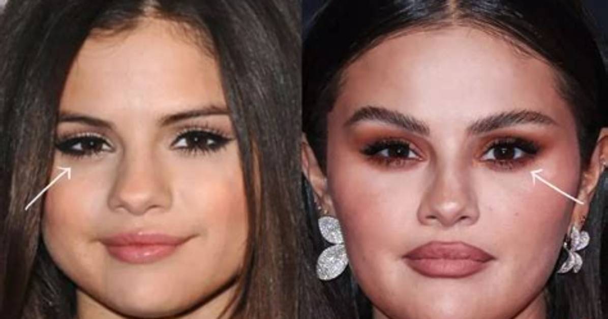 Did Selena Gomez Undergo ‘Fox Eye’ Surgery? Some Fans on Instagram Think So
