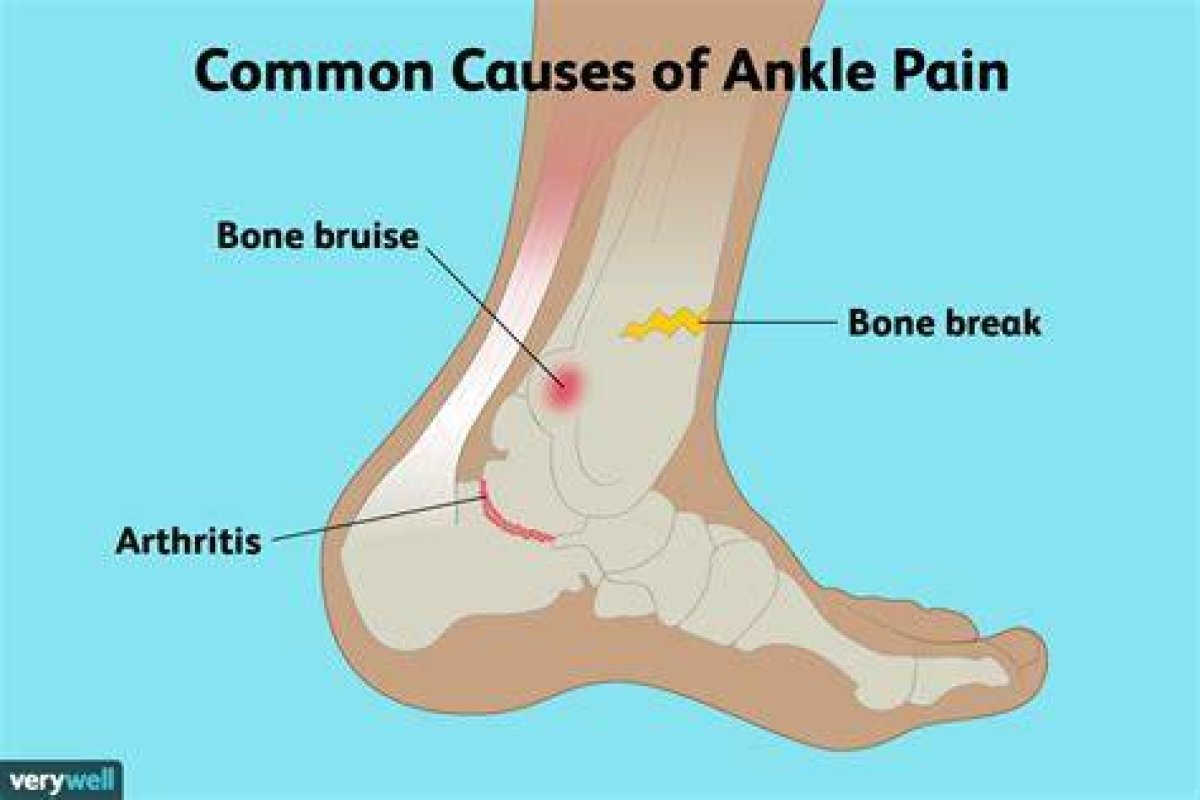 Do Crocs Cause Ankle Pain?