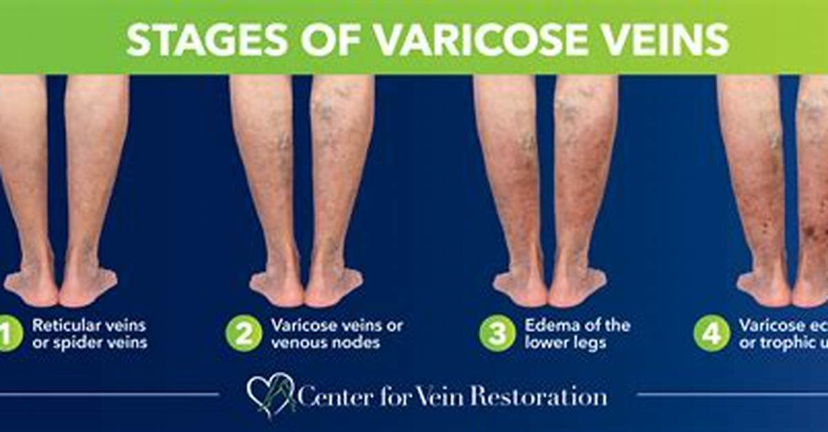 Does Acupuncture Help Varicose Veins?