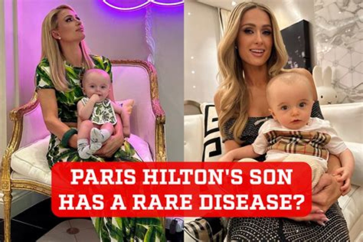 Does Paris Hilton's Baby Have Hydrocephalus? Understanding the Condition and Its Implications