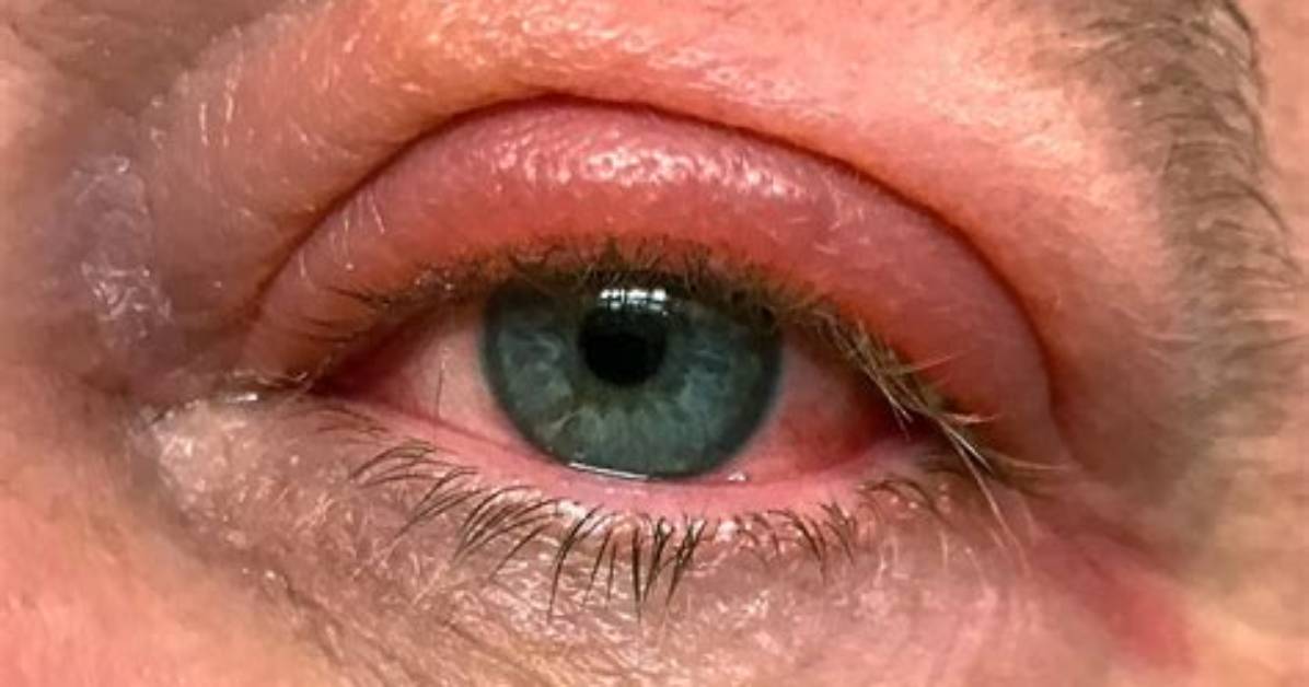 Eyelid Swelling