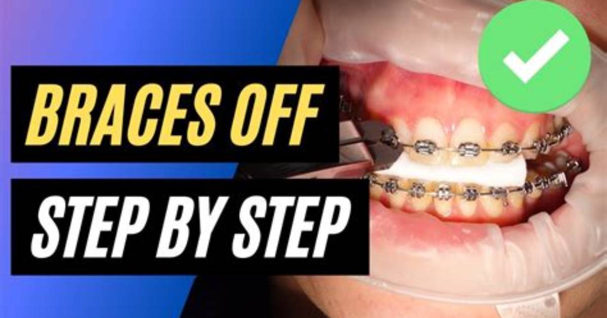 How Do They Remove Braces Glue?