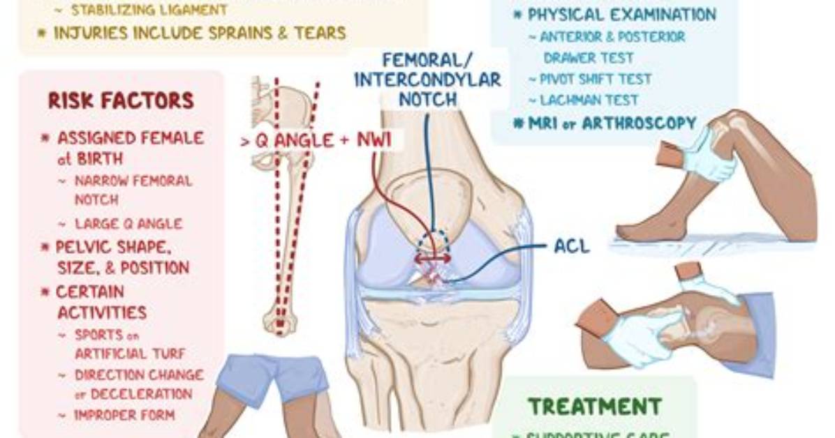 How Do You Test for Acl?