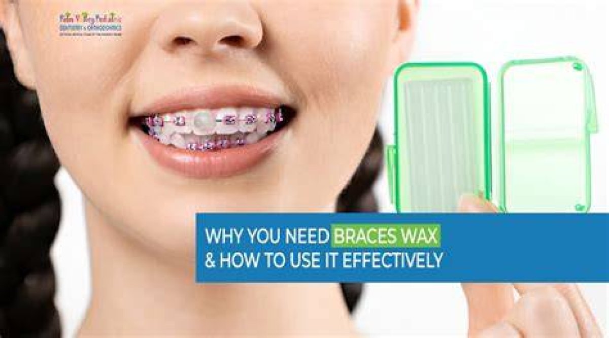 How to Use Wax for Brace?