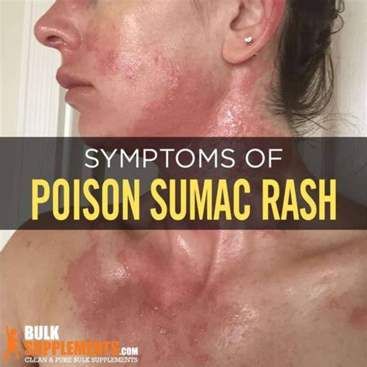 Itchy Reaction to Poison Sumac