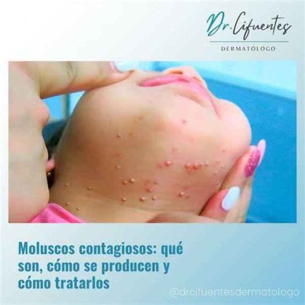 Los Moluscos Contagiosos, Una Infección De Transmisión Sexual