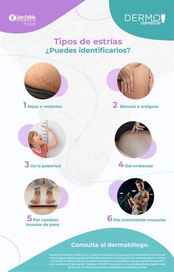 ¿Por Qué Aparecen Las Estrías En Las Uñas?