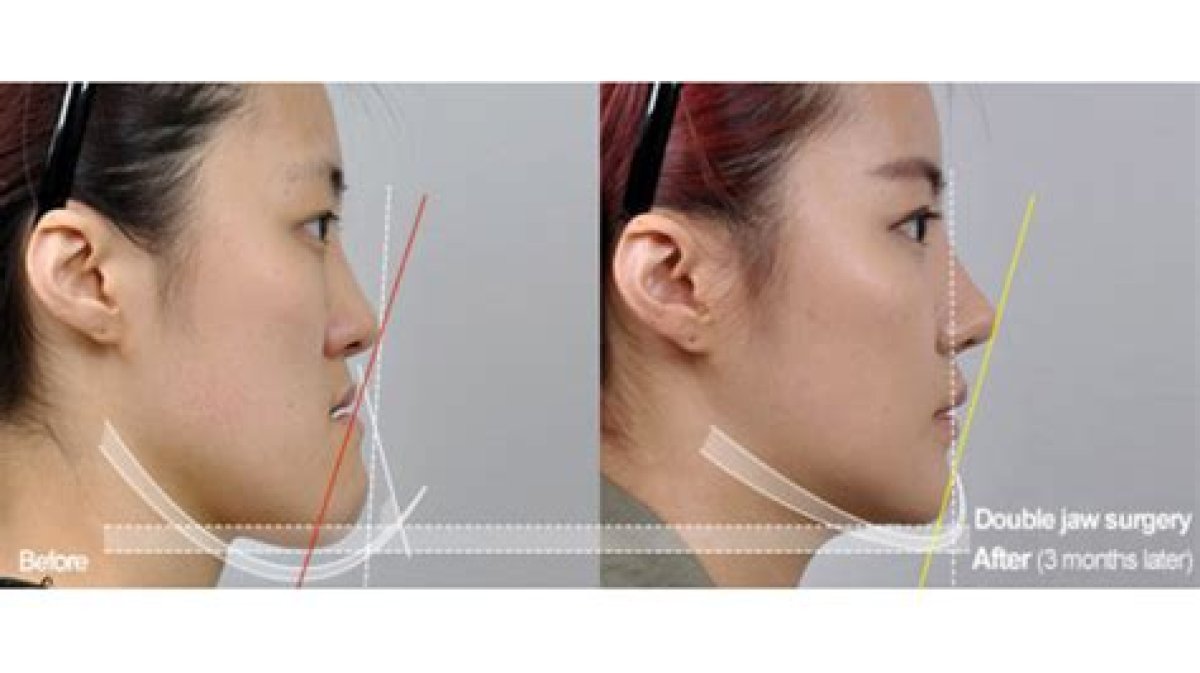 Risky Double-Jaw Surgery South Korea's Latest Cosmetic Fad