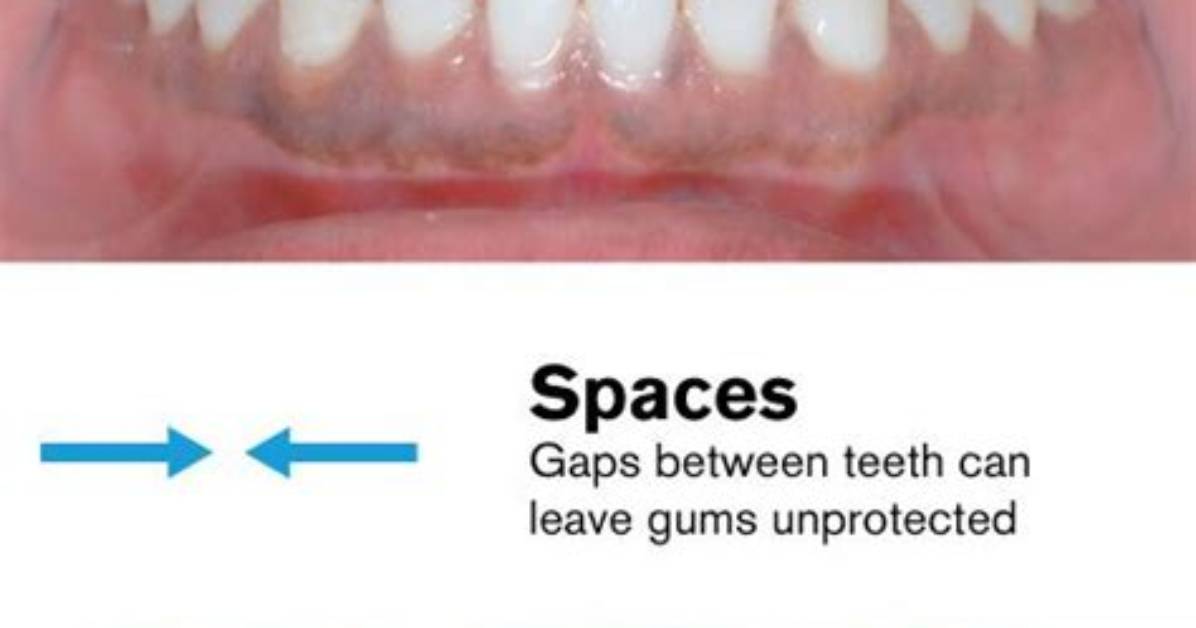 Spaces Where Teeth Are Missing