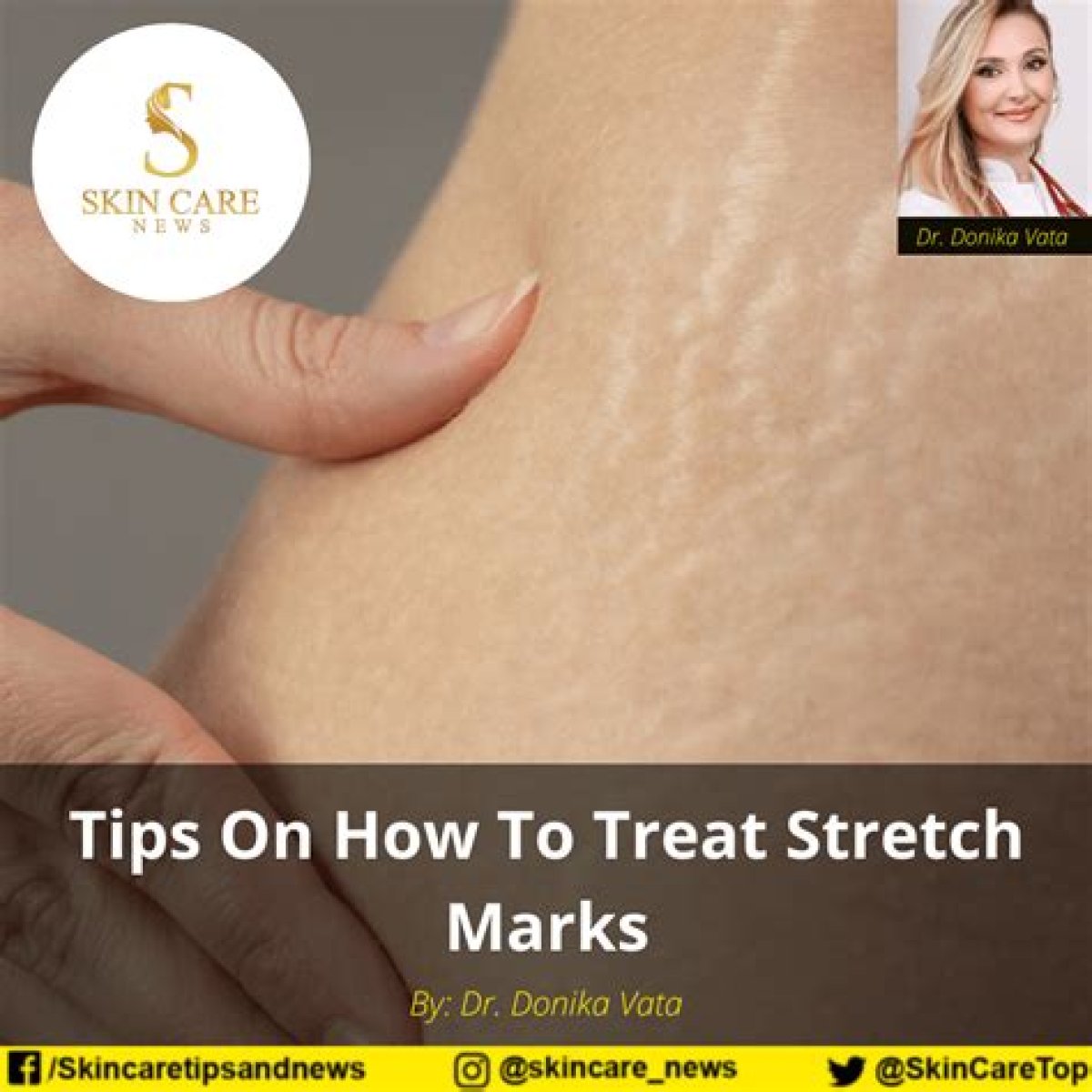 Stretch Marks - News, Tips & Guides