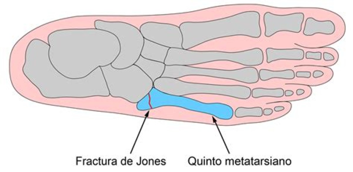 Tengo Una Fractura Del Quinto Metatarsiano, ¿Qué Hago?