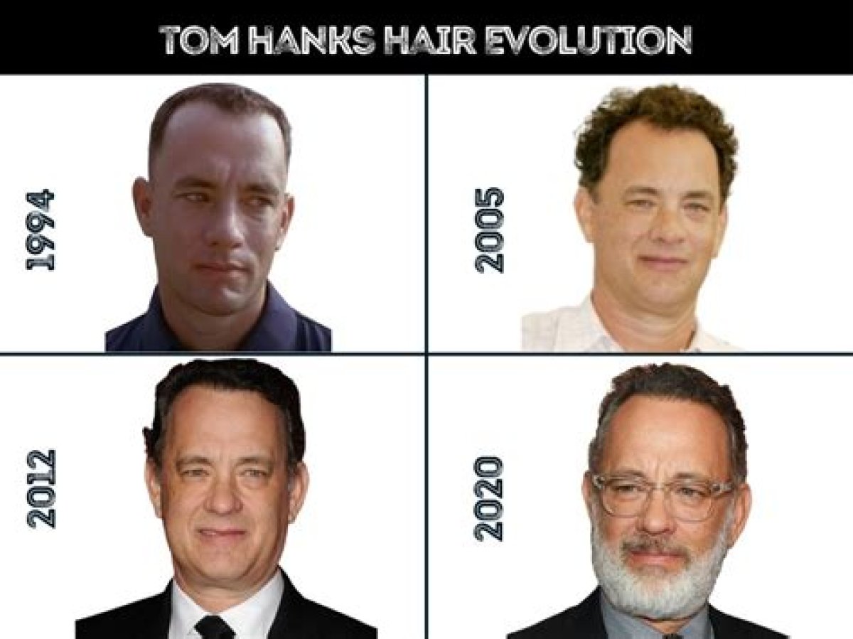 Unlocking the Secret Behind Tom Hanks’ Hair Transplant