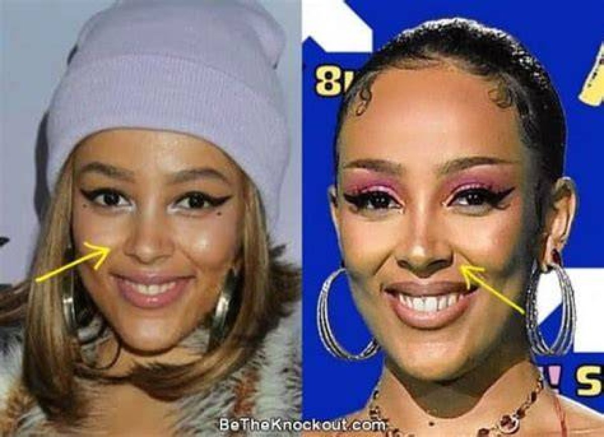 Unmasking Doja Cat’s Plastic Surgery: Facts, Controversies and Rumors