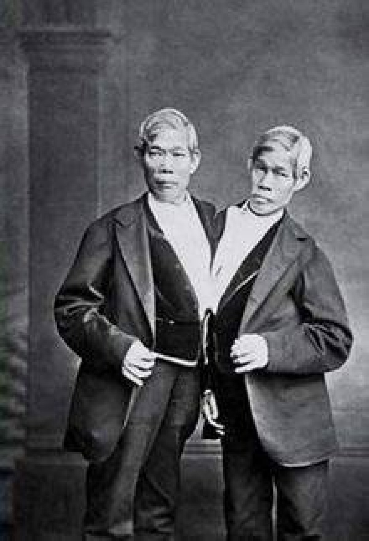 Were the Siamese Twins in the Greatest Showman Real?