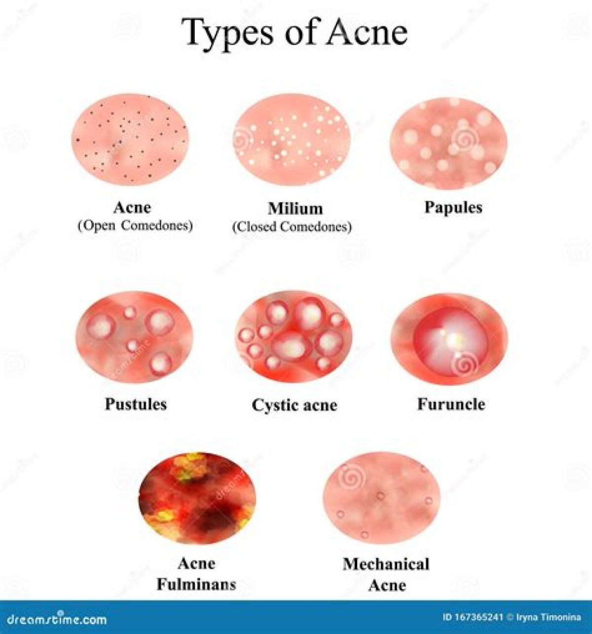 What Are Pustules and Papules?