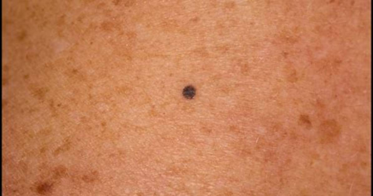 What Are Those Black Spots on Your Vag Lips?