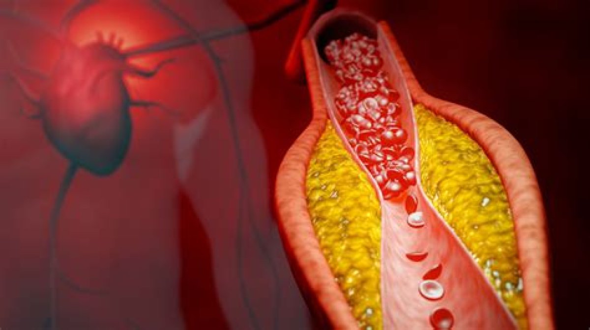 What Is Atherosclerotic Cardiovascular Disease? Know About Health Condition That Caused Carl Weathers' Death