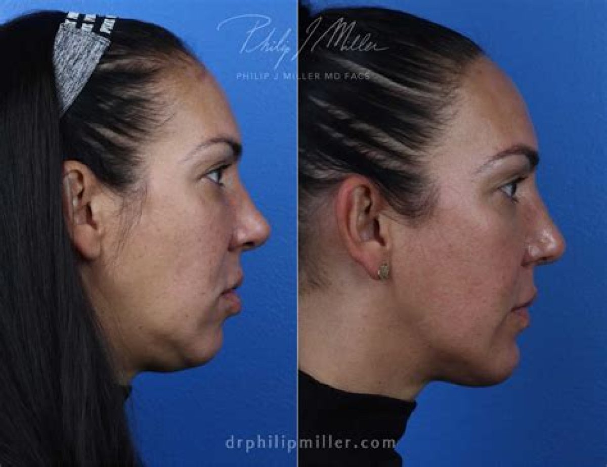What Is the Best Procedure to Remove Belly Fat?