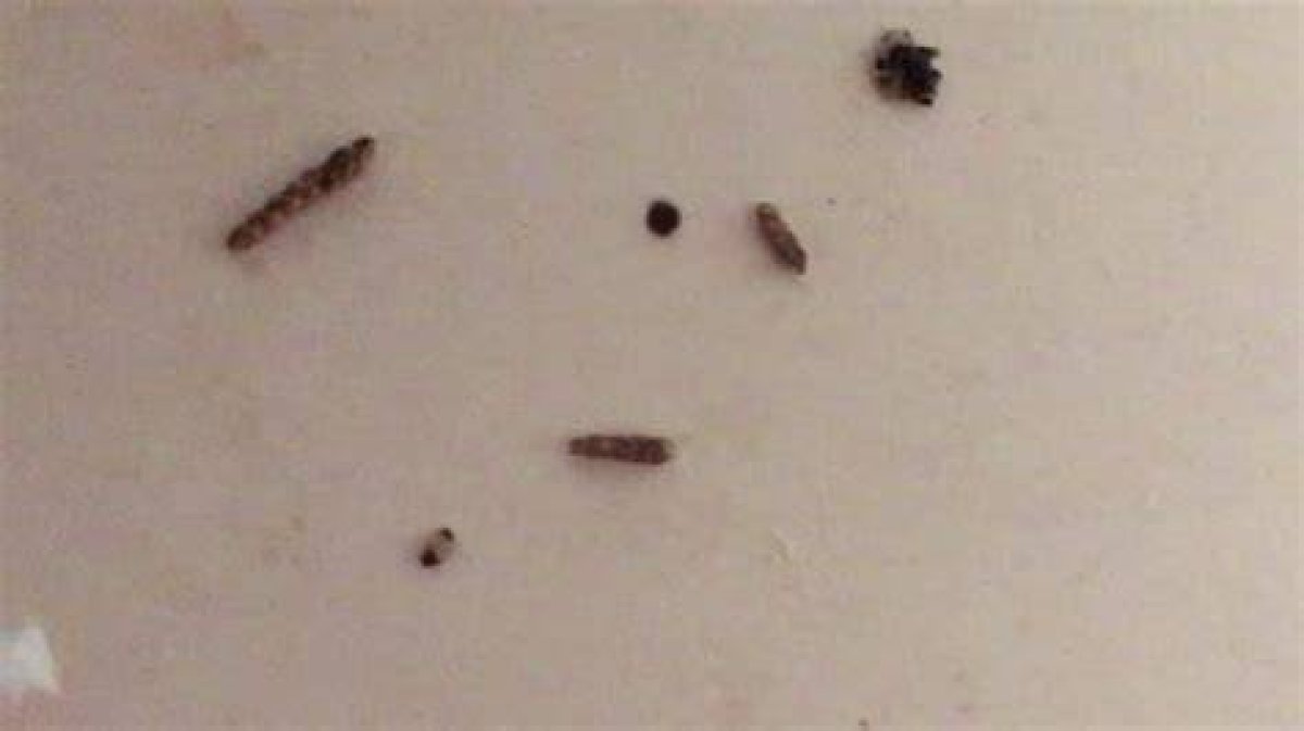 What Parasite Leaves Black Specks on Skin?