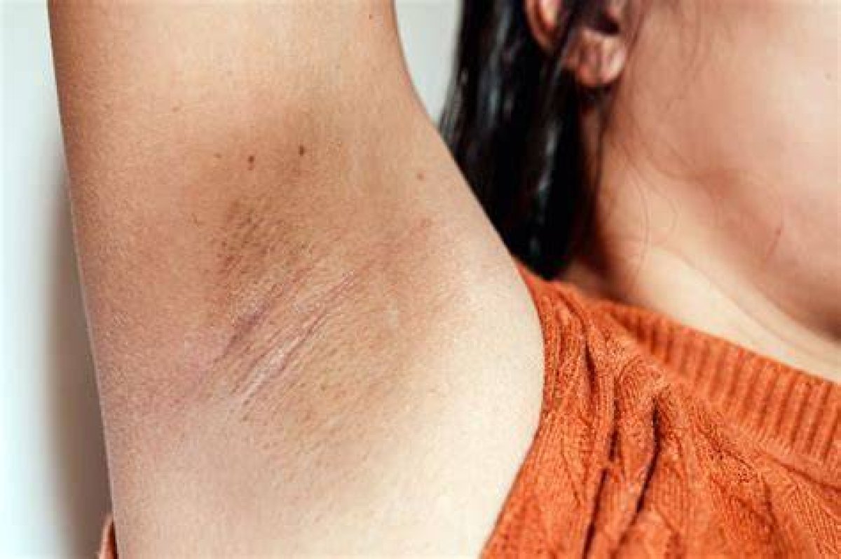 What Yellow Armpits Mean?