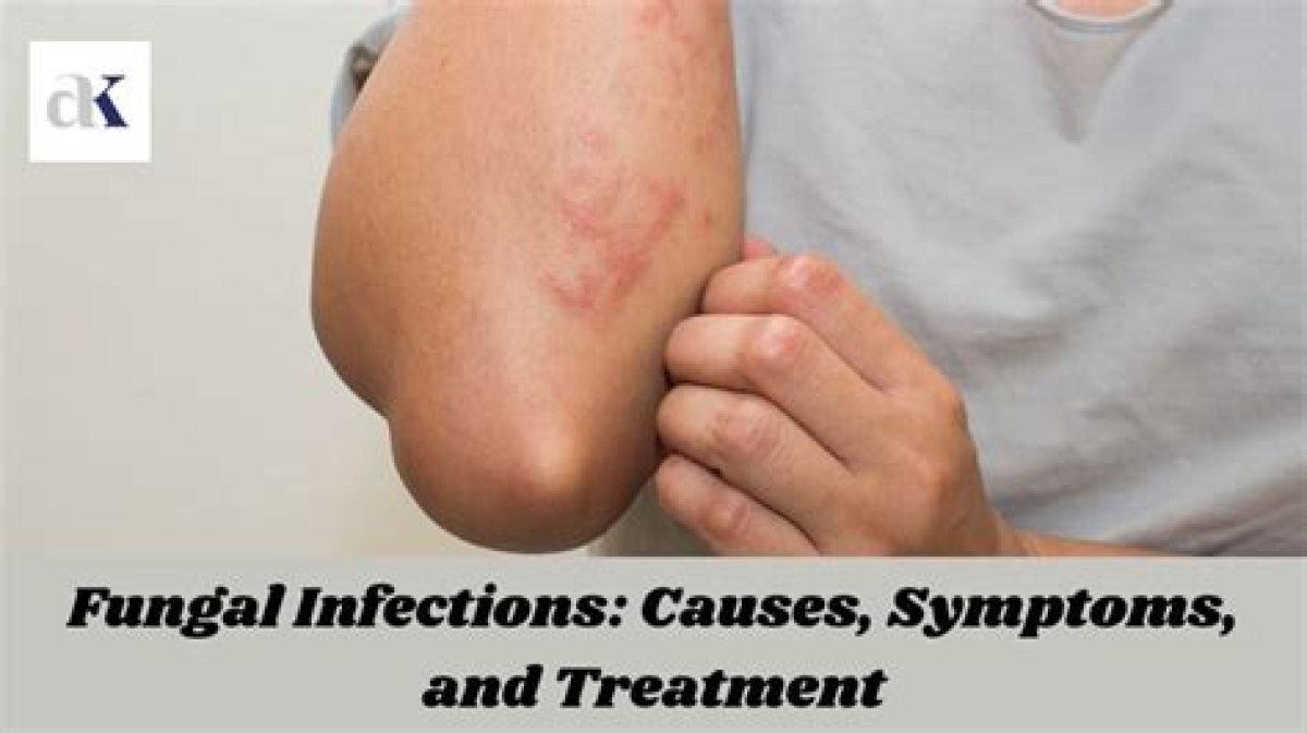 Why Am I Getting Fungal Infections?