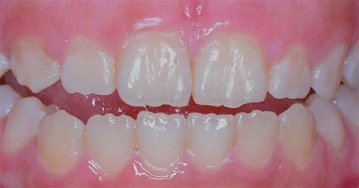 Why Do Teeth Have Ridges?