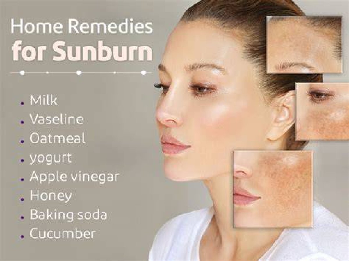 Why Honey Is the Best Sunburn Home Remedy