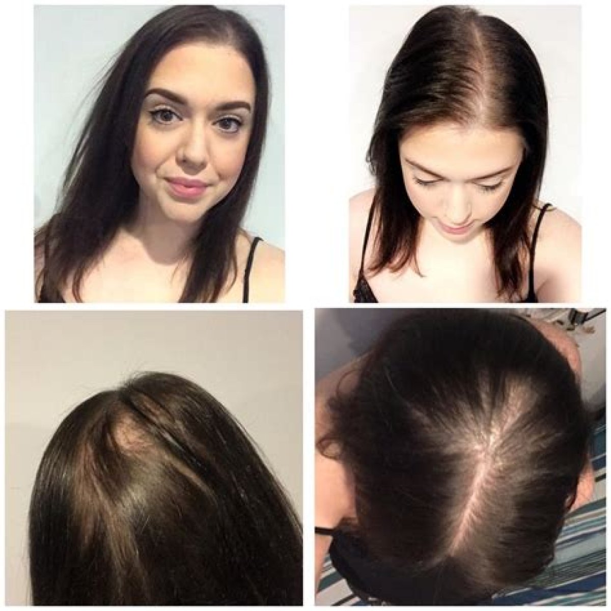 Why Is My Hair Thinning?