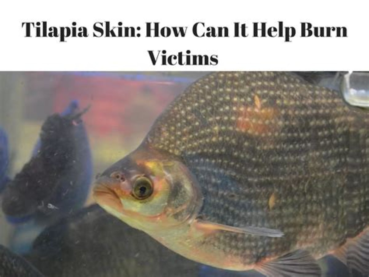 Why This Brazilian City Uses Tilapia Fish Skin to Treat Burn Victims